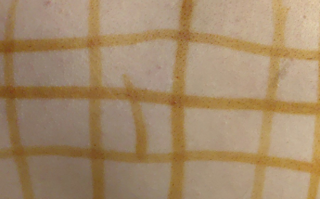 Как без анализов узнать, что в организме не хватает йода