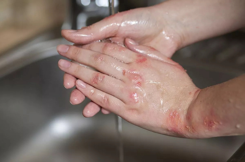 Учёные КубГМУ создадут импланты с матриклеточными белками для заживления ожогов