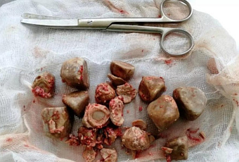 Врачи достали 300 граммов камней из мочевого пузыря пациентки