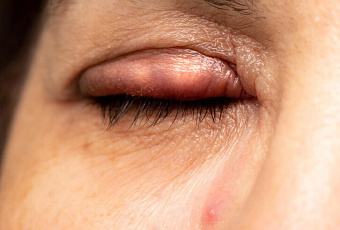 Как лечить ячмень: правильные способы, которые  помогут не доводить  до осложнений