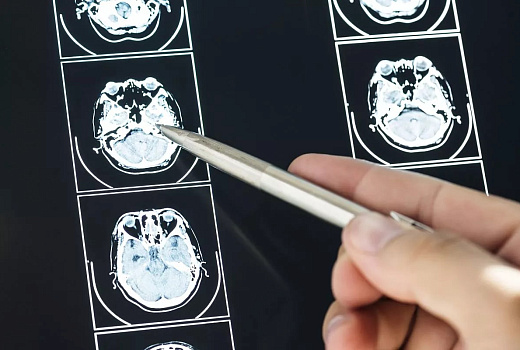 Российские ученые нашли новый метод персонализированной терапии глиом