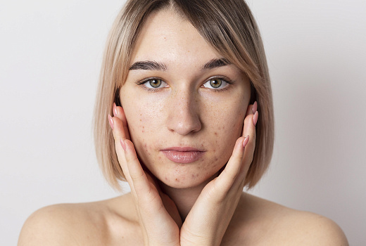 Акне часто появляется из-за неправильного ухода 