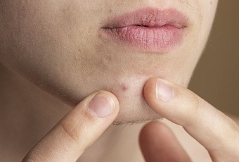 Опасное желание: почему самостоятельное удаление прыщей грозит проблемами