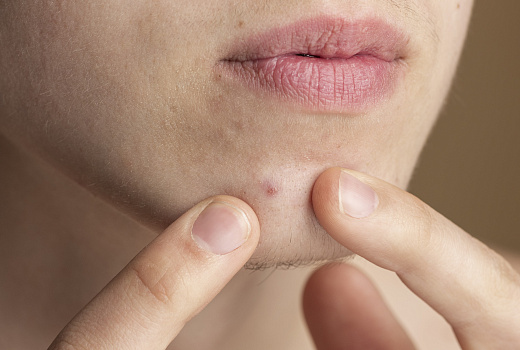 Опасное желание: почему самостоятельное удаление прыщей грозит проблемами