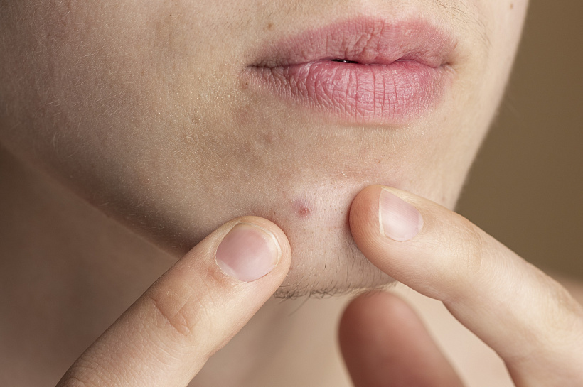 Опасное желание: почему самостоятельное удаление прыщей грозит проблемами