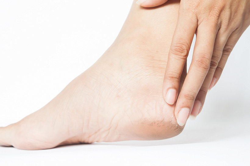 Шаг на встречу комфорту: простые способы забыть о натоптышах 