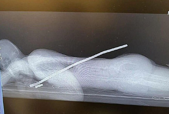 Сочинские врачи «выключили» мужчине лёгкое